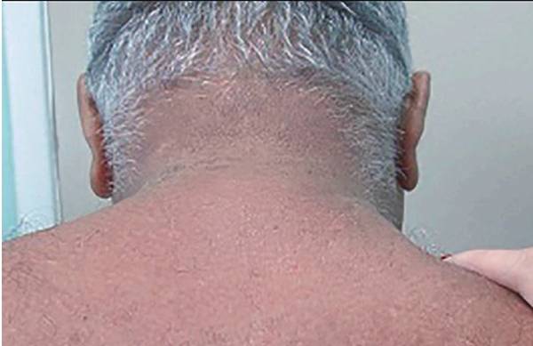 اسکلرودرما دیابتیکروم