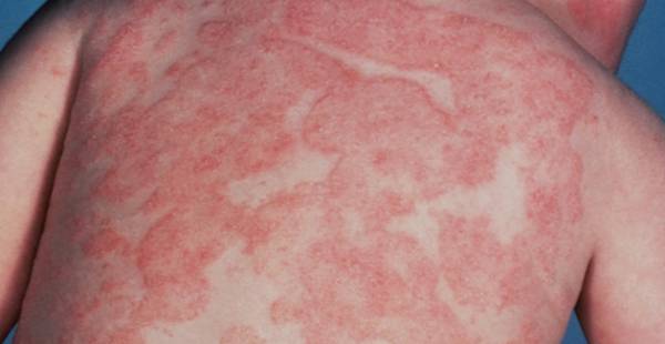 عفونت قارچی 