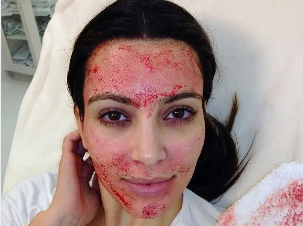  میکرونیدلینگ صورت