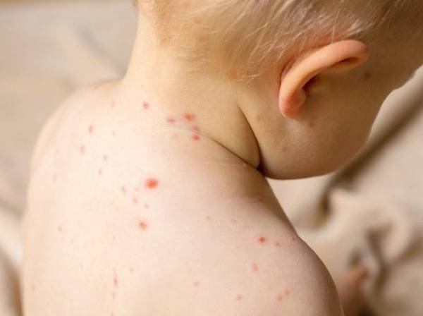 بیماری سرخک