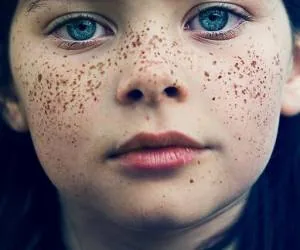 ضایعات پیگمانته