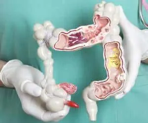 دیورتیکولیت