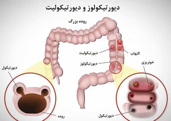 دیورتیکولیت