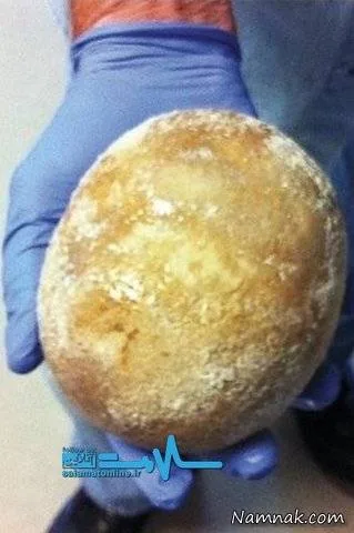 سنگ مثانه
