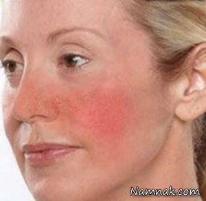 11 تکنیک برای محافظت از پوست های حساس