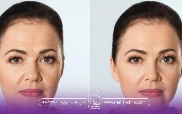 عکس قبل و بعد فردی که پروفایلو استراکچرا تزریق کرده است