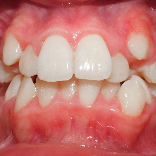 بهم ریختگی شدید دندان که نیاز به ارتودنسی دارد