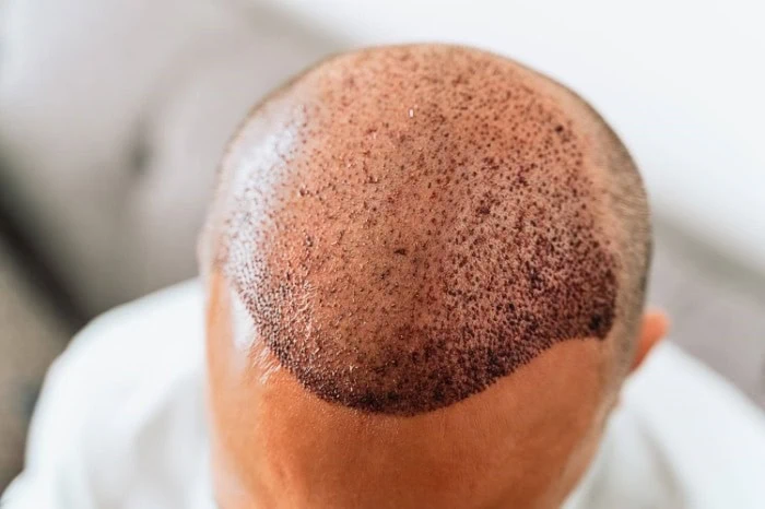Hair Transplant Scabs:What Are They & How To Deal With Them   Dr Serkan Aygin Clinic