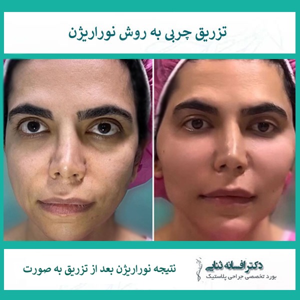 تصویر قبل و بعد از تزریق نوراریژن