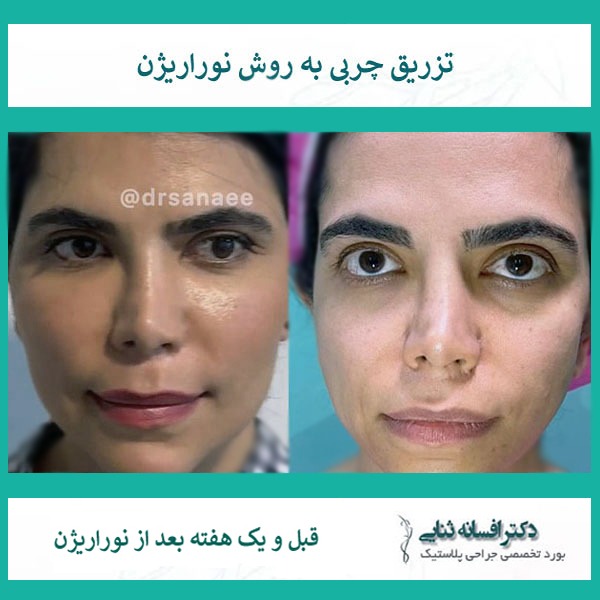 تصور قبل و بعد از تزریق نوراریژن   یک هفته بعد و بهبود صورت