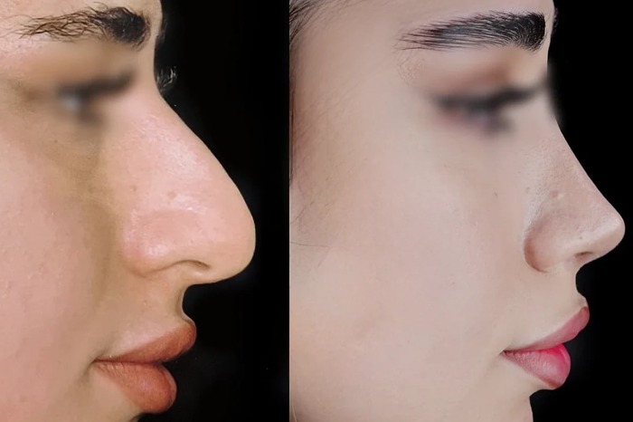 ویژگی‌های بینی استخوانی