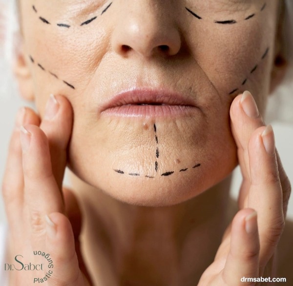 جراحی لیفت صورت