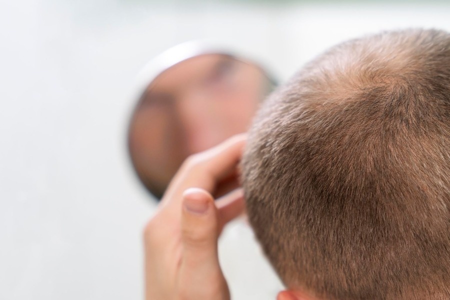 چرا موهای کاشته شده دیر رشد میکند؟