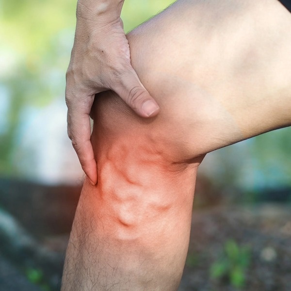 علائم اولیه واریس پا؛ نشانههایی که نباید نادیده گرفته شوند واریس پا