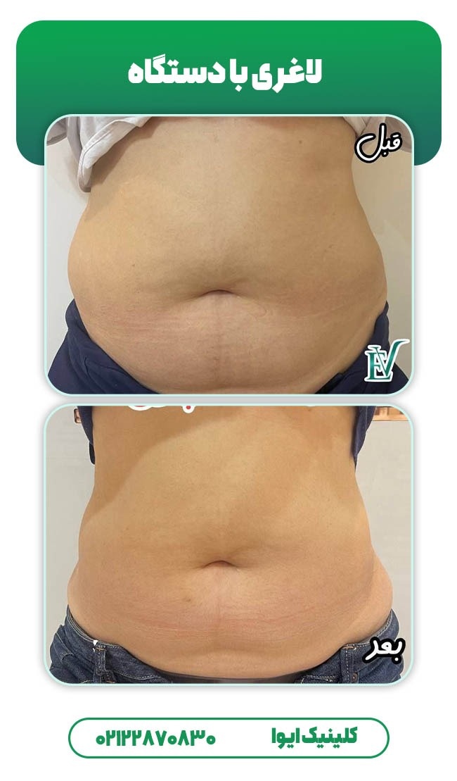 لاغری موضعی با دستگاه