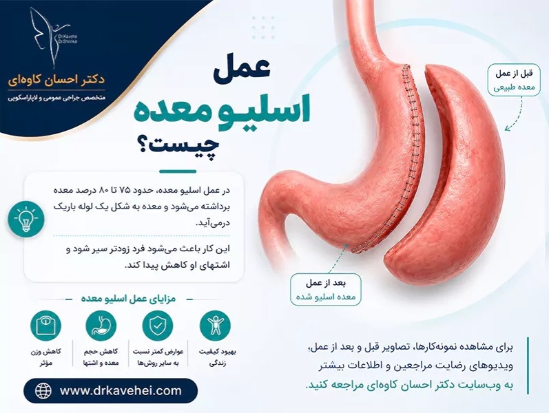 عمل اسلیو معده چیست؟ بهترین جراح اسلیو معده 