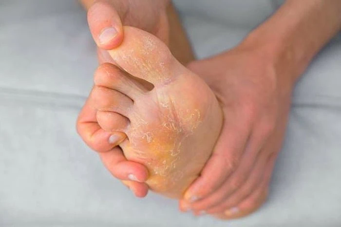 علائم کهیر زدن