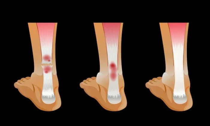 انواع شکستگی استخوان شکستگی بسته