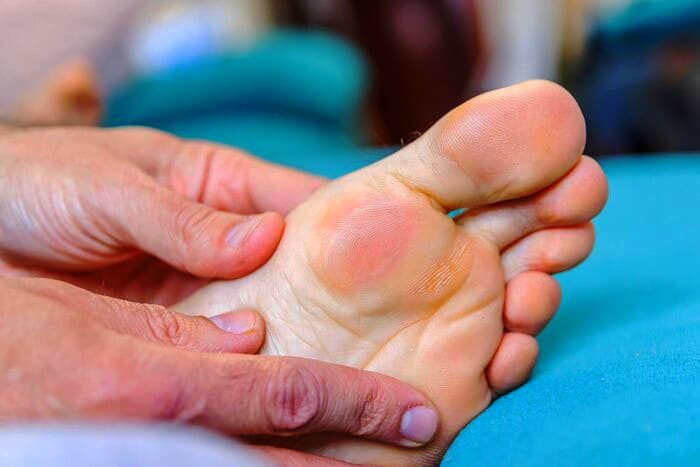 درمان سریع تاول پا 