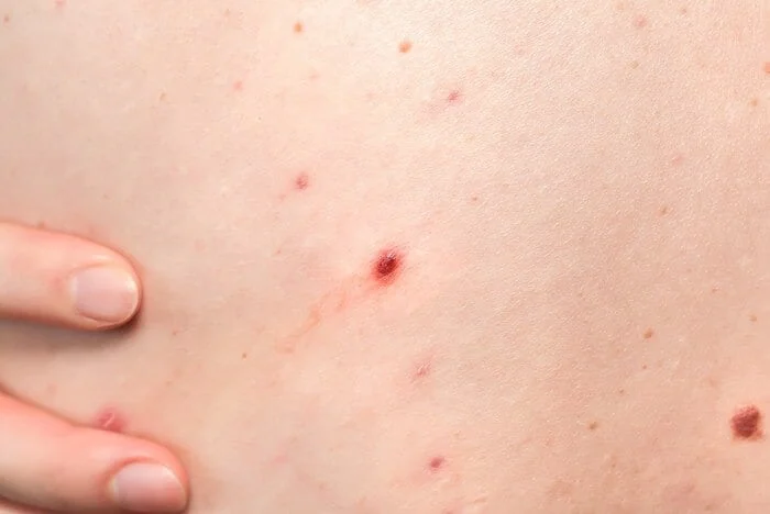 علل جوش زدن کمر