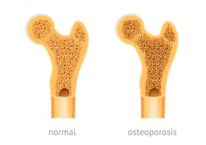 پوکی استخوان