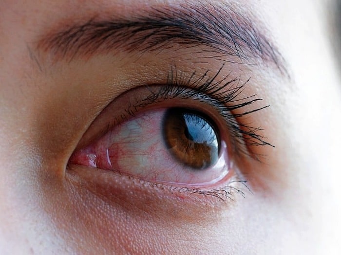 درمان خانگی رفع قرمزی چشم