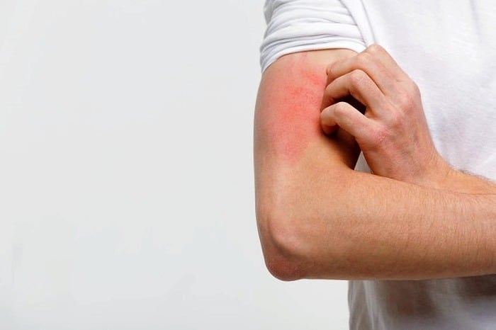 حساسیت پوستی