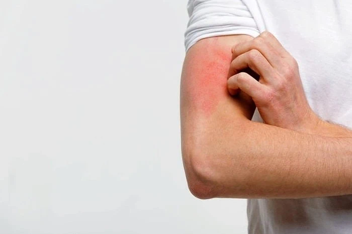 اگزما پوستی