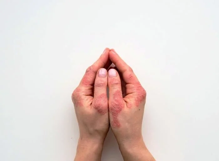 التهاب پوستی