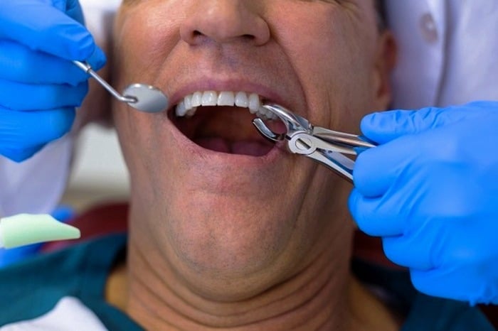 عوارض کشیدن دندان عقل پایین
