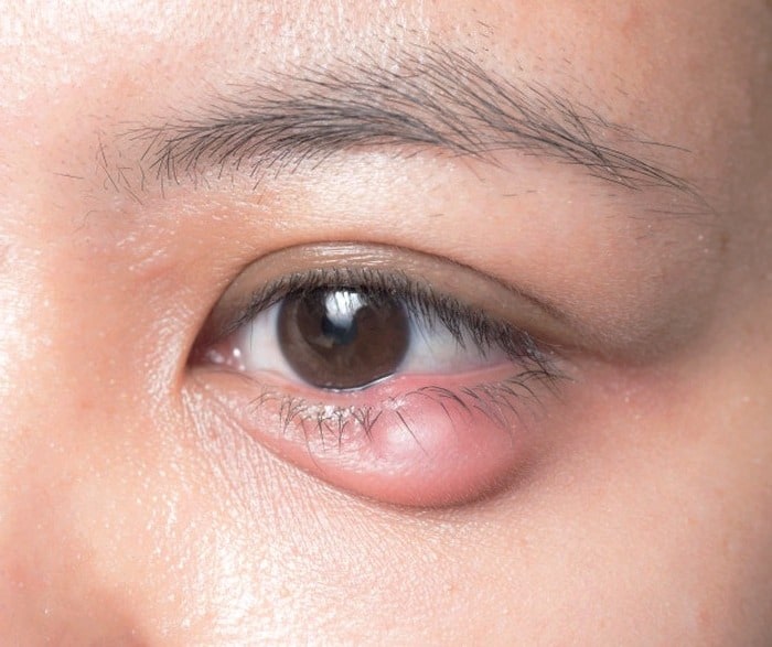 مهم ترین علت قی کردن چشم ها چیست؟