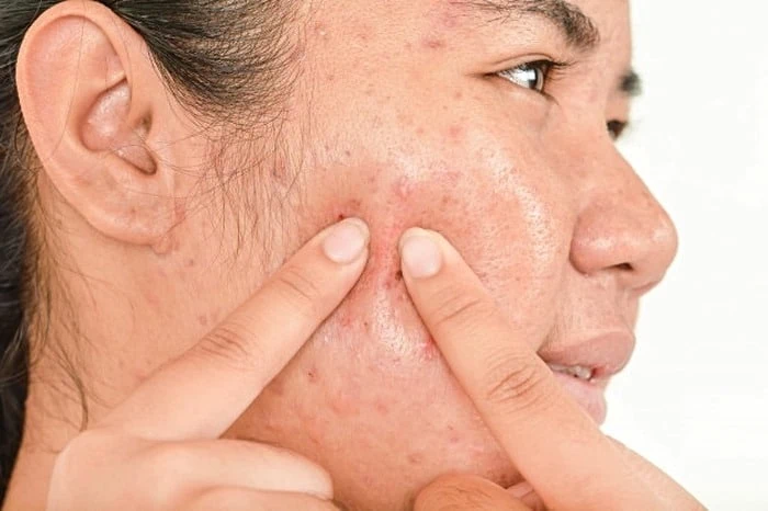 ماسک پوست موز برای جوش
