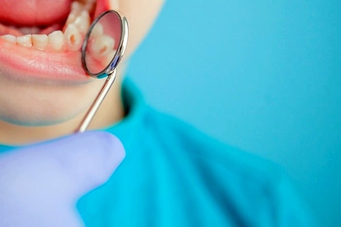 پوسیدگی دندان