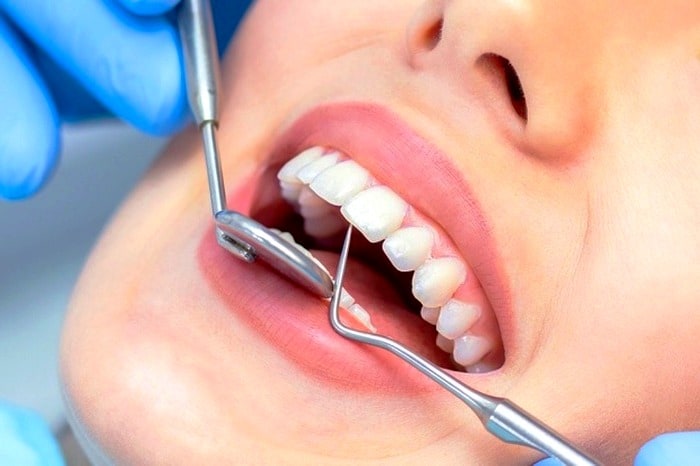 زمان کشیدن دندان عقل