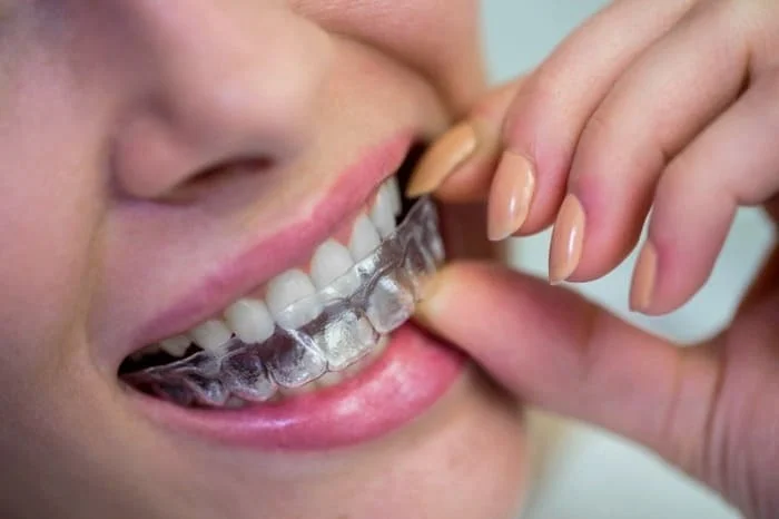 ساختن روکش