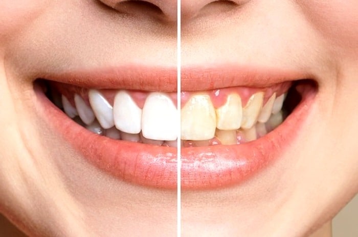 سرکه سیب سفید کننده دندان سفیدکننده دندان