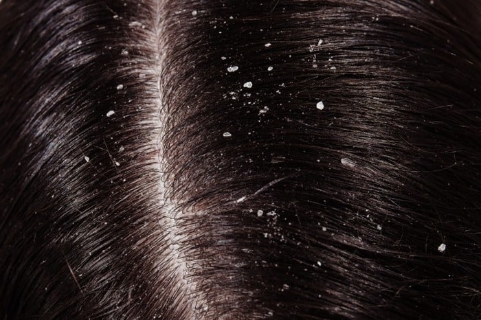 سرکه سیب برای درمان شوره سر پوسته و شوره سر