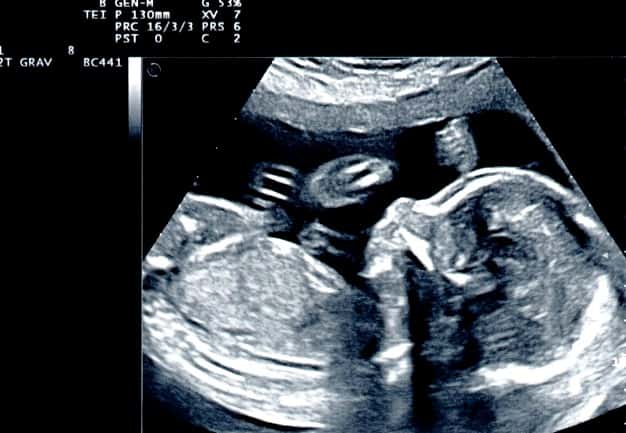  عوارض سونوگرافی بارداری