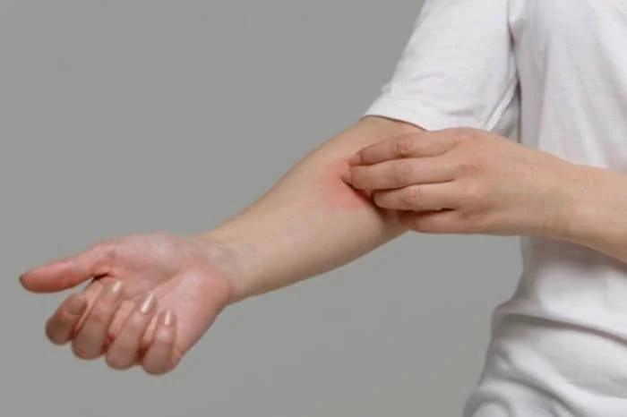 پیشگیری از آلرژی