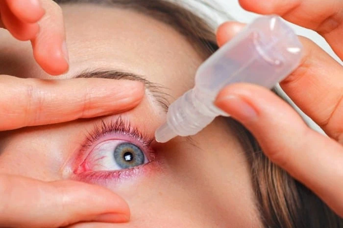 قطره برای آلرژی چشم