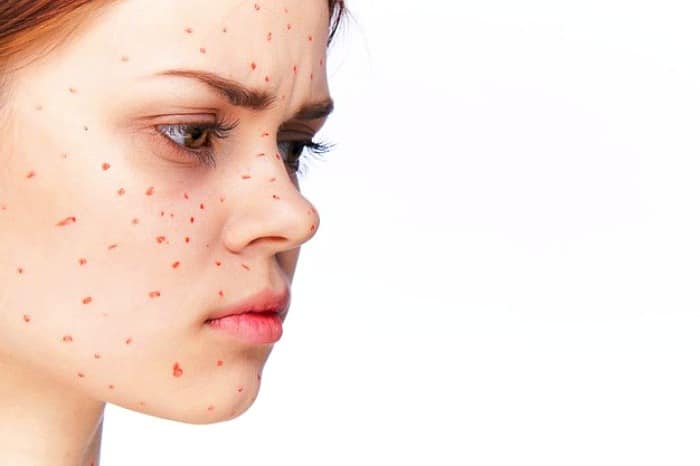 سرکه سیب برای آکنه آکنه