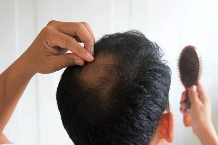 آب آهن دار مانع ریزش مو می شود
