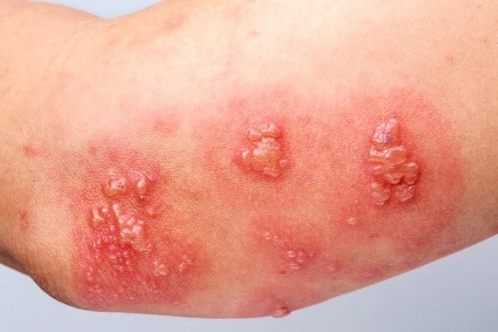 بیماری زونا چه خطراتی دارد؟