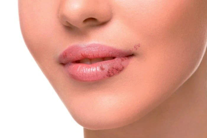 تبخال دهانی ایدز