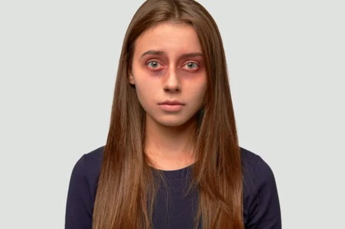 درمان تیرگی چشم با شنبلیله شنبلیله برای تیرگی چشم