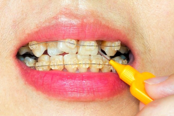نحوه مراقبت از دندان ارتودنسی