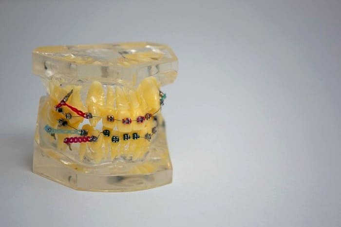 اثرات بد ارتودنسی معایب ارتودنسی