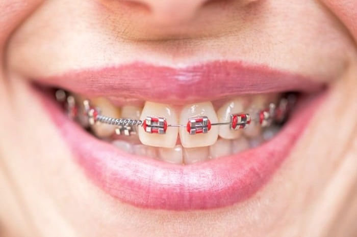 انواع مشکلات ارتودنسی عوارض ارتودنسی