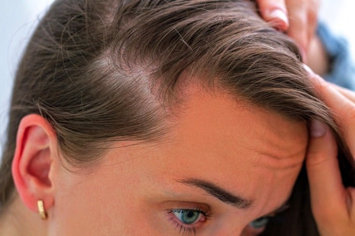درمان های ریزش موی ارثی