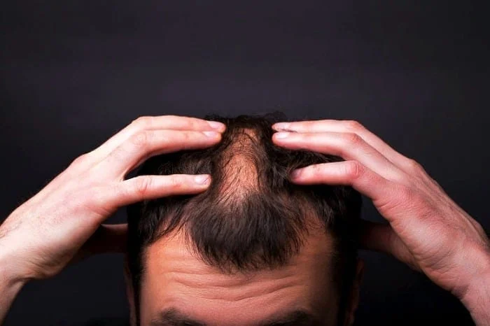 تخمه آفتابگردان برای ریزش مو کنترل ریزش مو